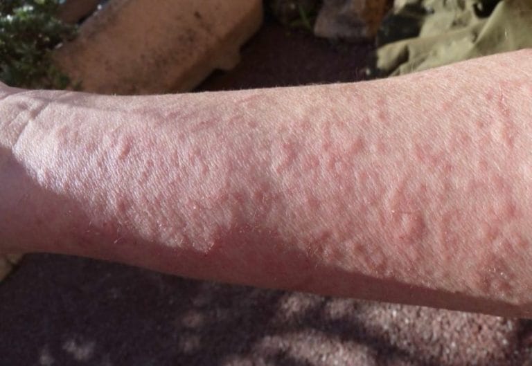 Mengenal Dermatitis Kontak Gejala Penyebab Dan Pengobatan