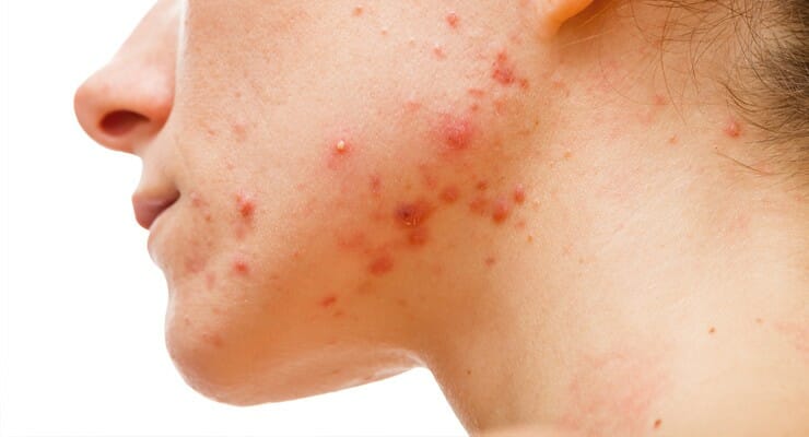 mengenal apa itu acne