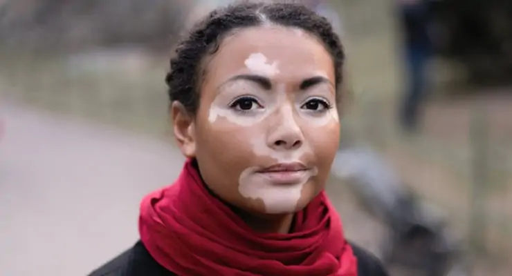 apa itu penyakit vitiligo
