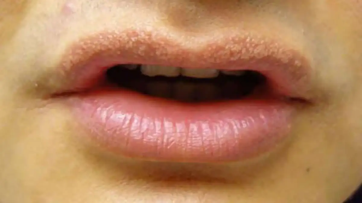 Bintik putih di bibir Fordyce Spots