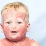 Tips Rawat Kulit Anak dari Dermatitis Atopik