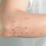 ciri-ciri penyakit kulit