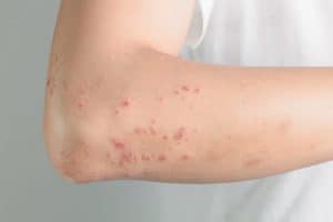 ciri-ciri penyakit kulit