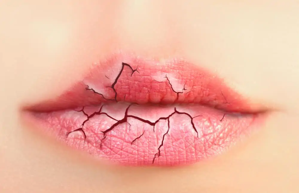 cara mengatasi bibir kering saat puasa