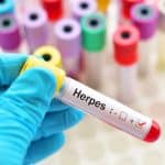 penyakit herpes disebabkan oleh apa