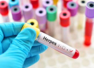 Penyakit Herpes Disebabkan Oleh Apa Sih Sebenarnya?