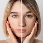 Skin Booster: Cara Kerja, Manfaat, & Efek Samping untuk Kulit