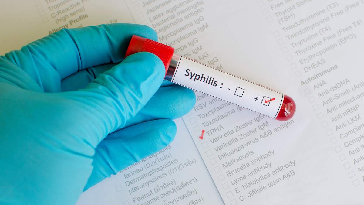 Tes Sifilis untuk Mengetahui Stadium Sifilis