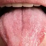 Apa itu Gonore Mulut? Ketahui Tanda-Tanda & Pencegahannya