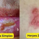 Perbedaan Herpes Simplex dan Zoster - Klinik Kulit dan Kelamin