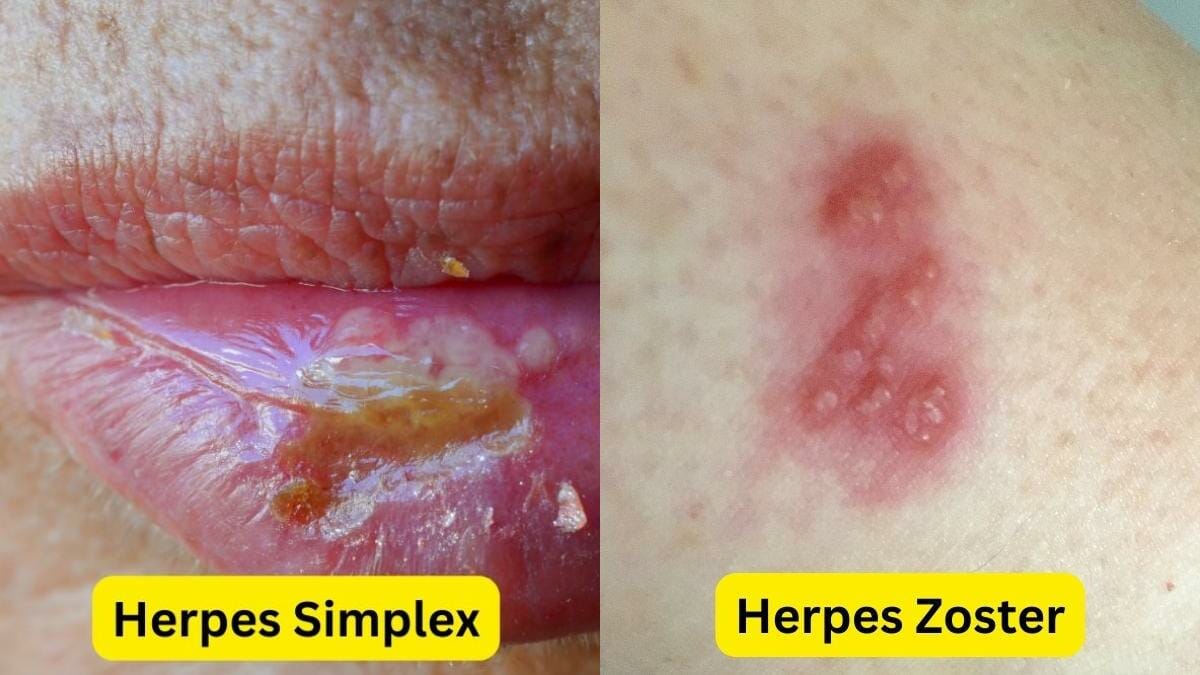 Perbedaan Herpes Simplex dan Zoster