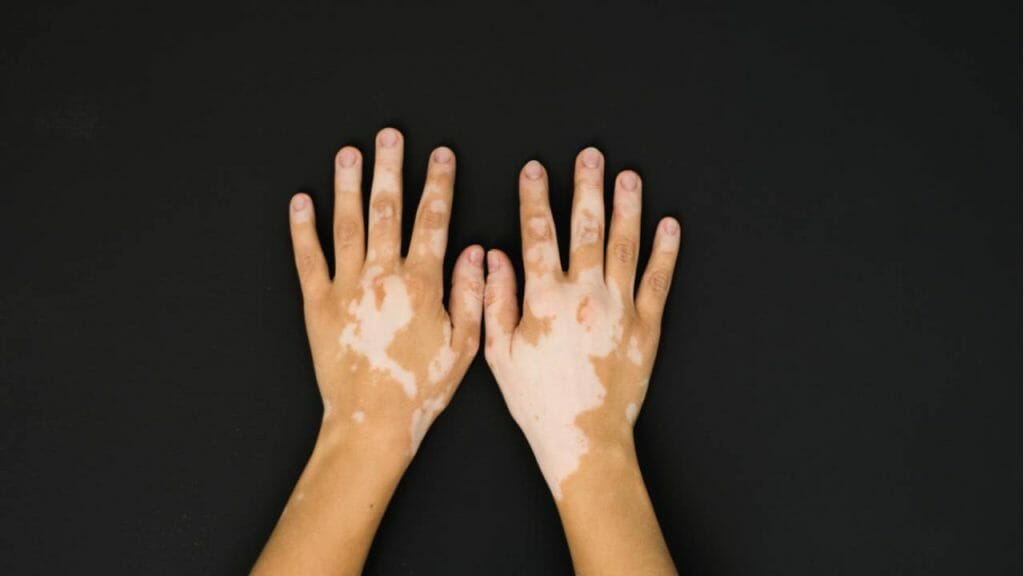 Tips Perawatan Kulit Vitiligo