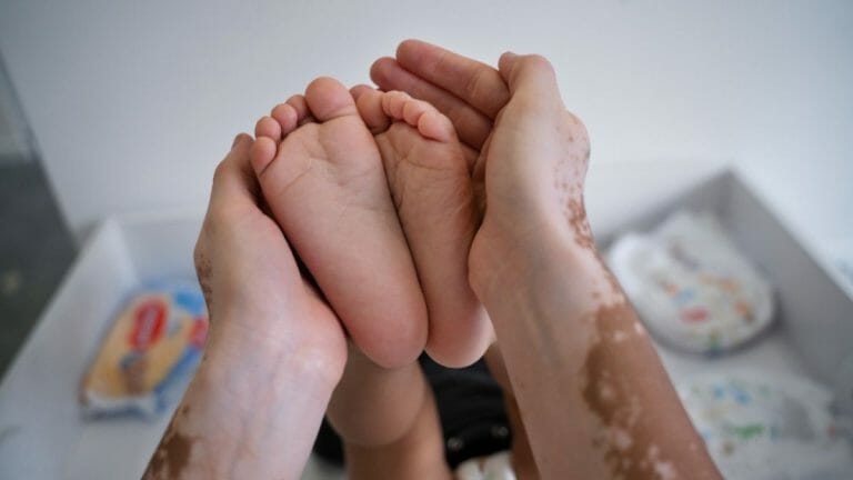 kisah penderita vitiligo