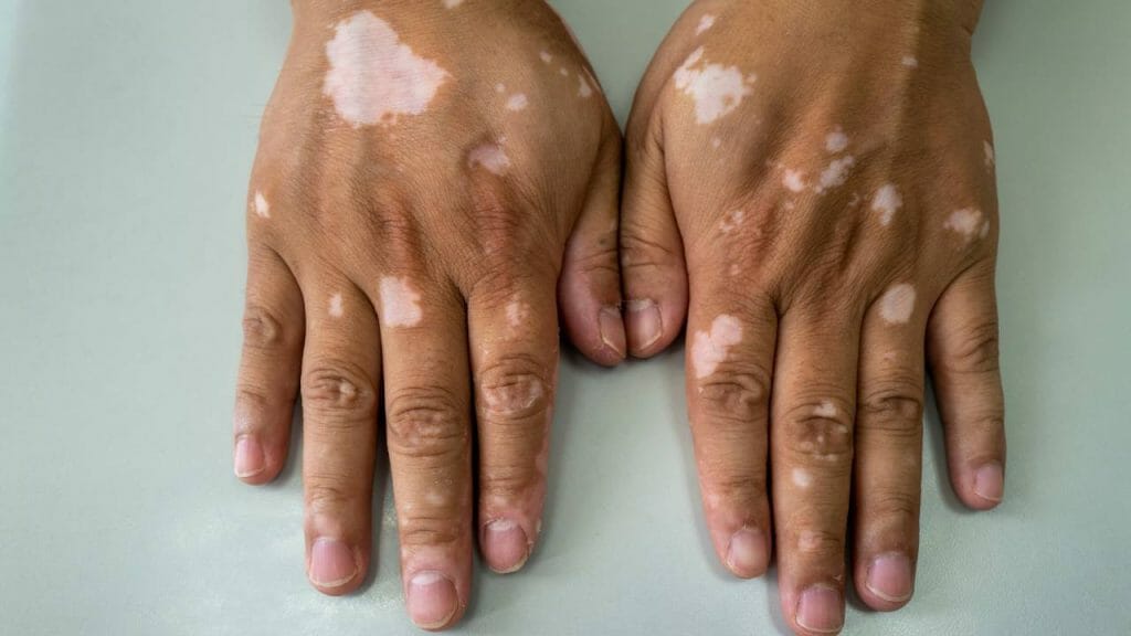 Buah Apa Yang Bagus Untuk Penderita Vitiligo