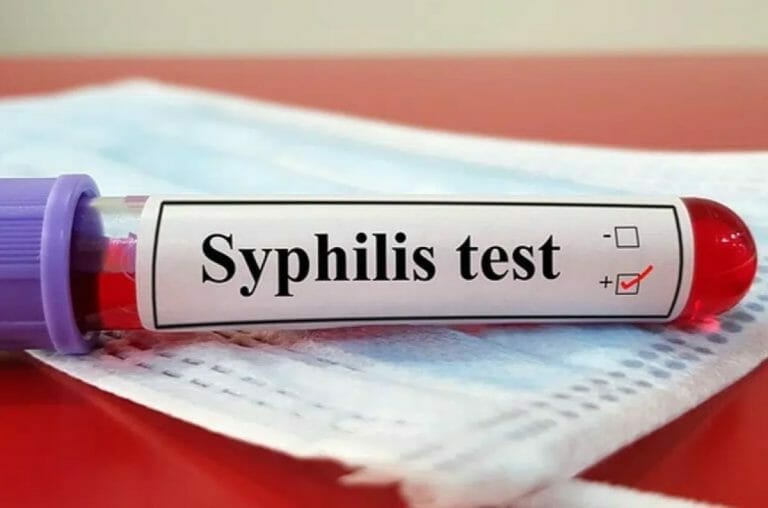 Pertanyaan Tentang Sifilis