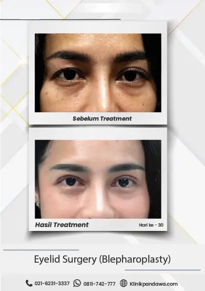 Before After Blepharoplasty - Novi Tresna