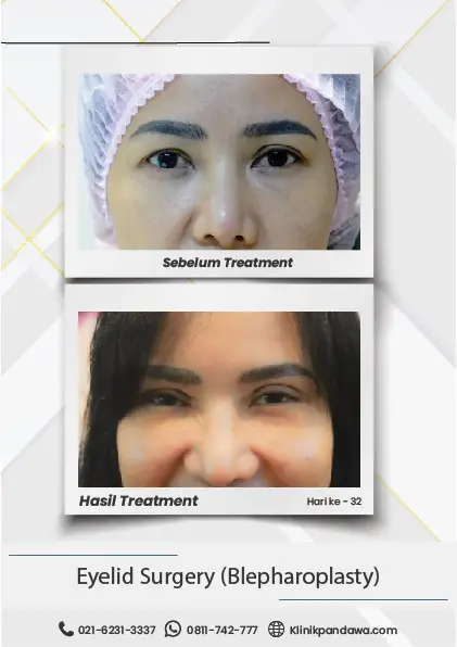 Before After Blepharoplasty