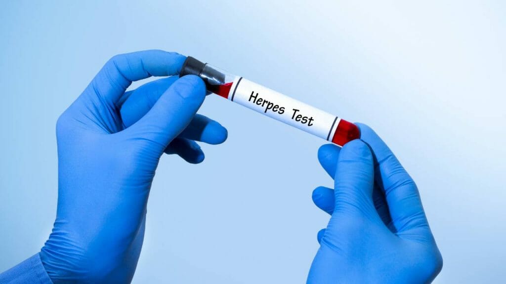 Diagnosis Herpes Genital Herpes Simplex