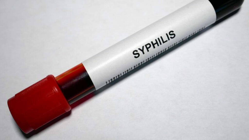 Pemeriksaan Sifilis Pada Ibu Hamil