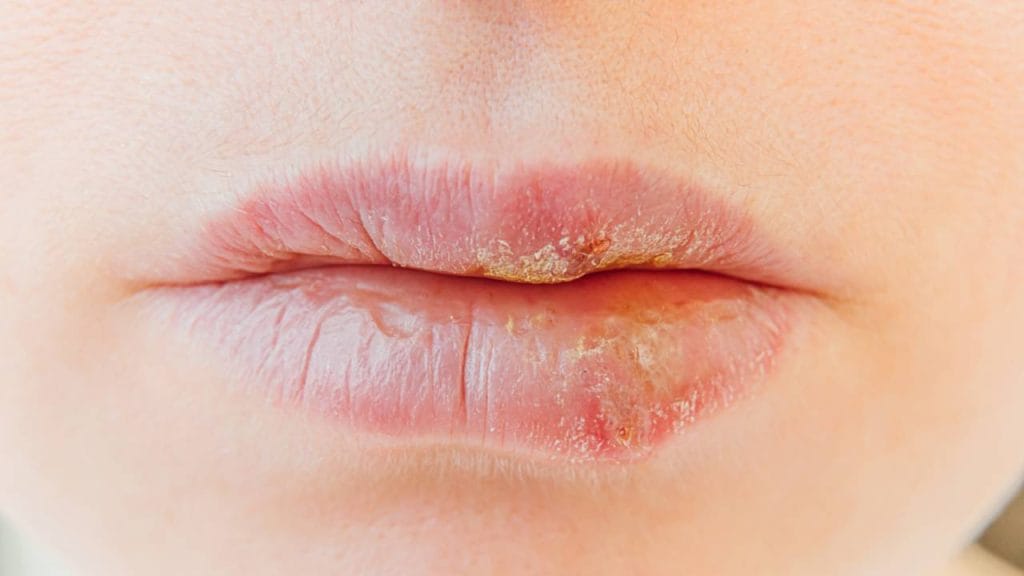 Pengobatan Herpes Bibir