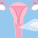 Mengenal Kandidiasis Vaginalis Penyebab, Gejala, dan Pengobatannya