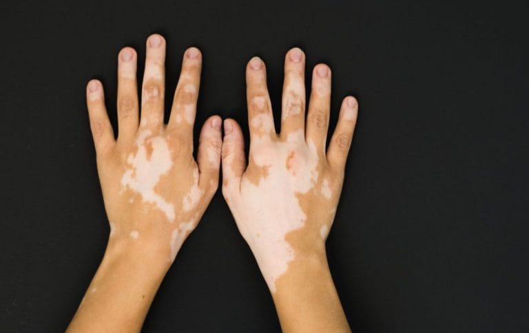 Apakah Penyakit Vitiligo Bisa Sembuh Ini Jawabannya