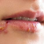 Ini Cara-Cara Ampuh Mengobati Herpes di Bibir