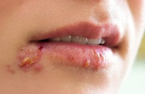 Ini Cara Cara Ampuh Mengobati Herpes Di Bibir