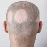 Rambut Tiba-Tiba Rontok Parah, Hati-Hati Alopecia Areata