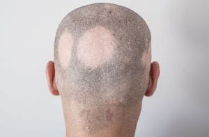 Rambut Tiba Tiba Rontok Parah Hati Hati Alopecia Areata