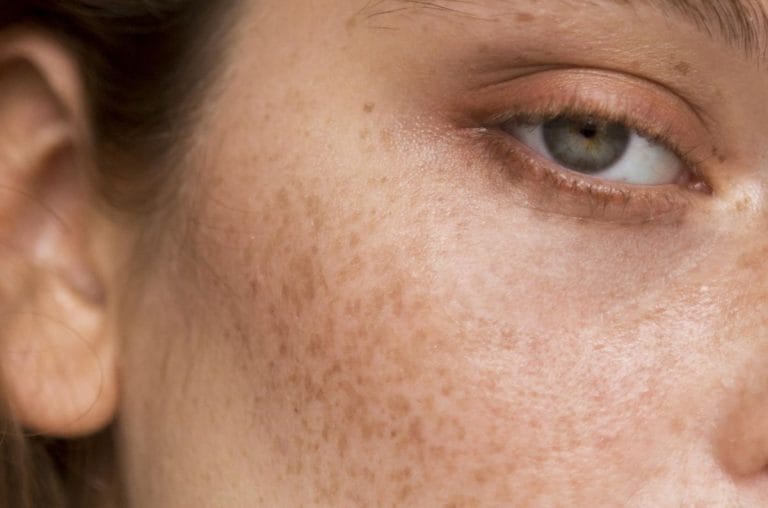 cara menghilangkan melasma