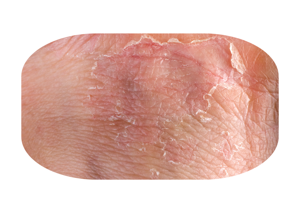 Gejala Dermatitis