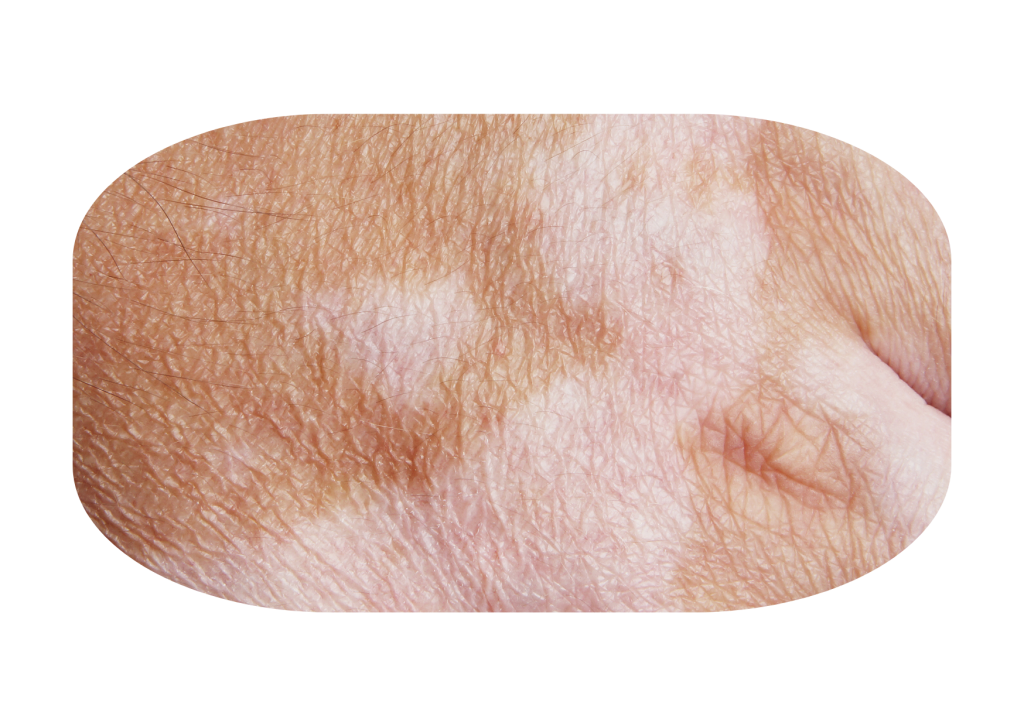 Gejala vitiligo 1