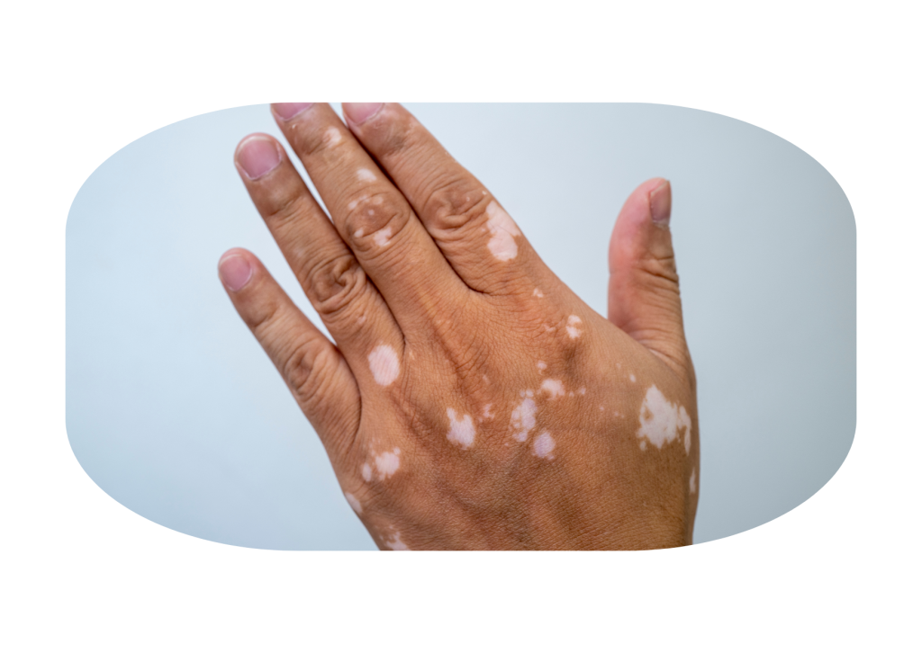 Gejala vitiligo 2