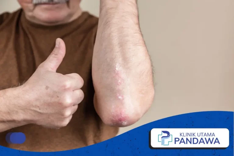 tanda psoriasis sembuh