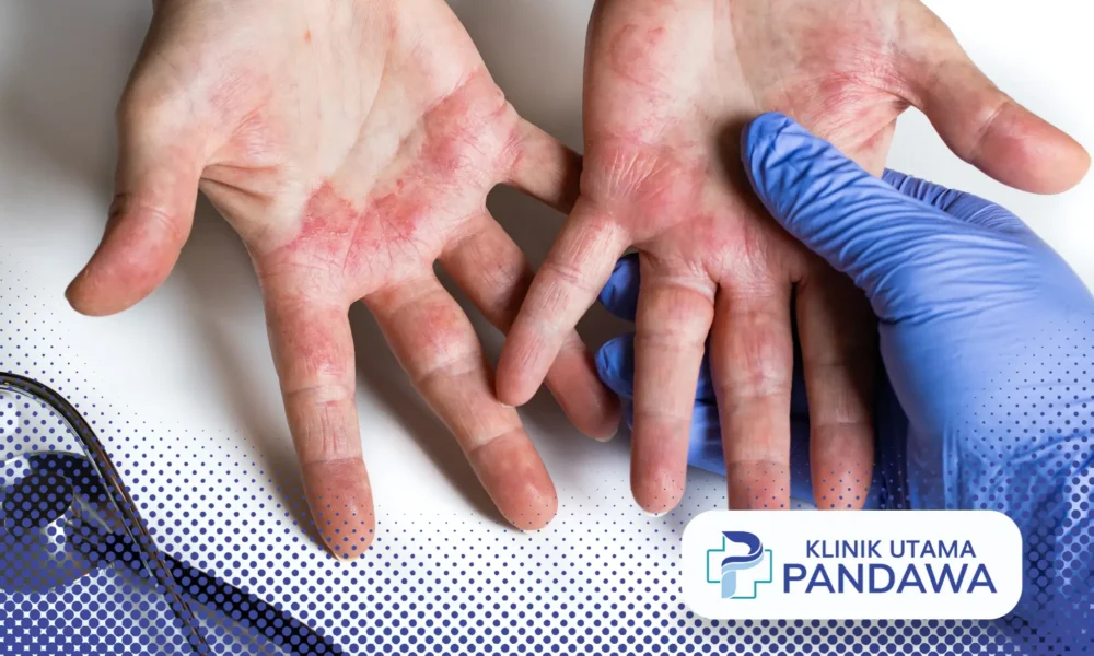 Dermatitis numularis