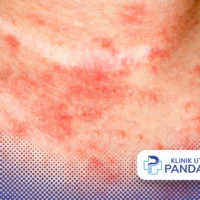 bintik merah gatal menyebar
