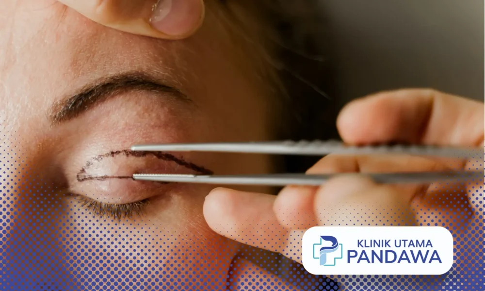 blepharoplasty