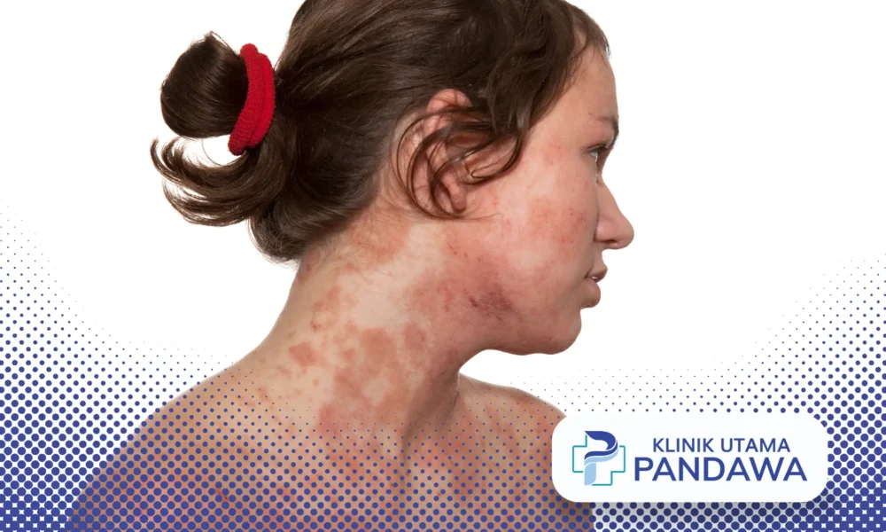 dermatitis atopik