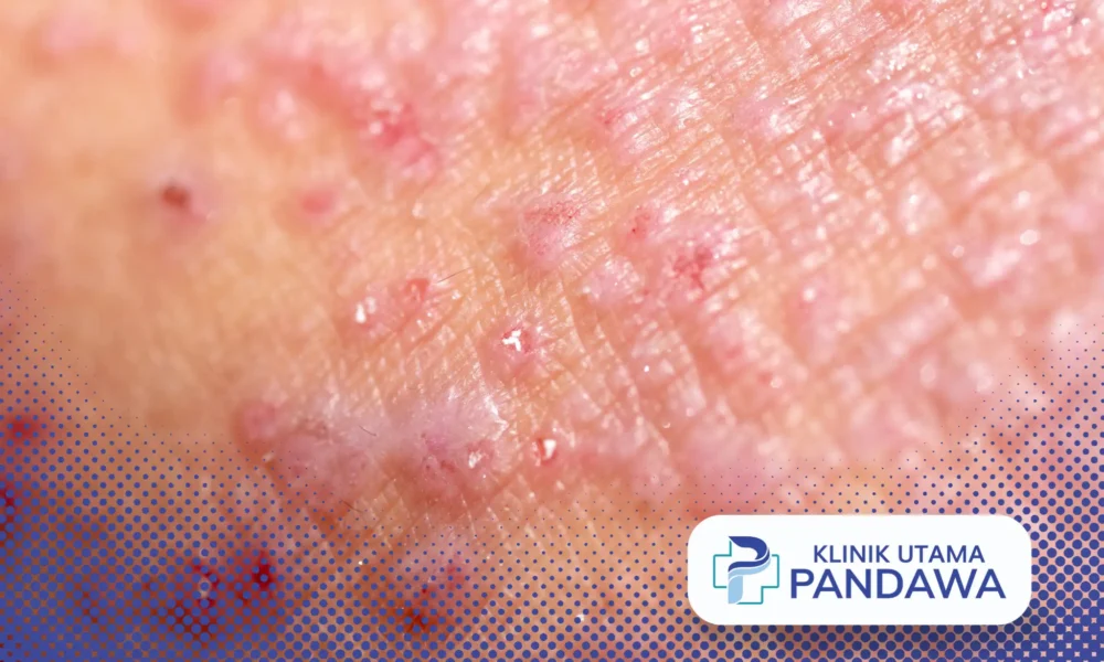 dermatitis herpetiformis