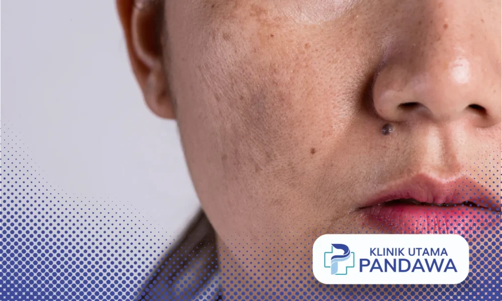 melasma