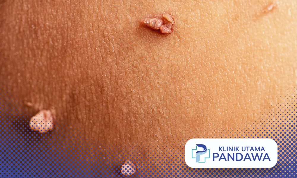 skin tag