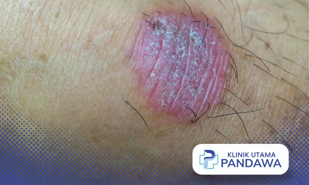 tinea cruris