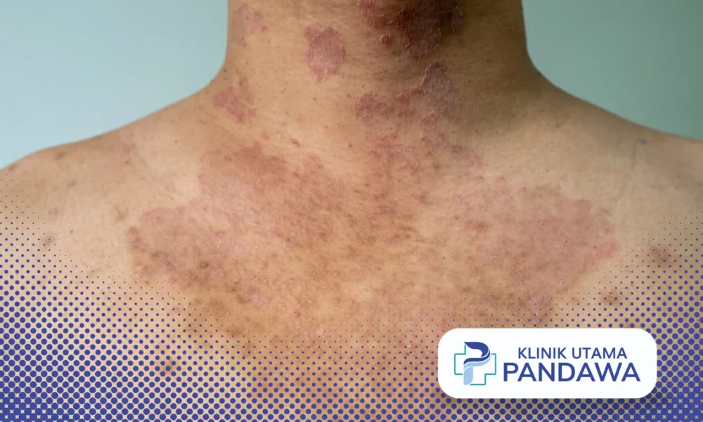 tinea fasialis adalah