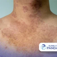 tinea fasialis adalah