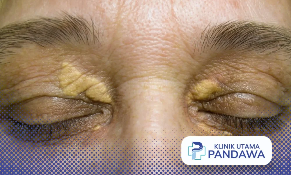 xanthelasma