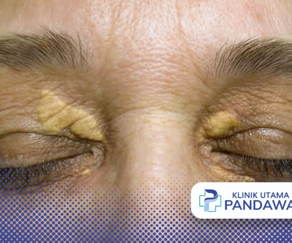 xanthelasma