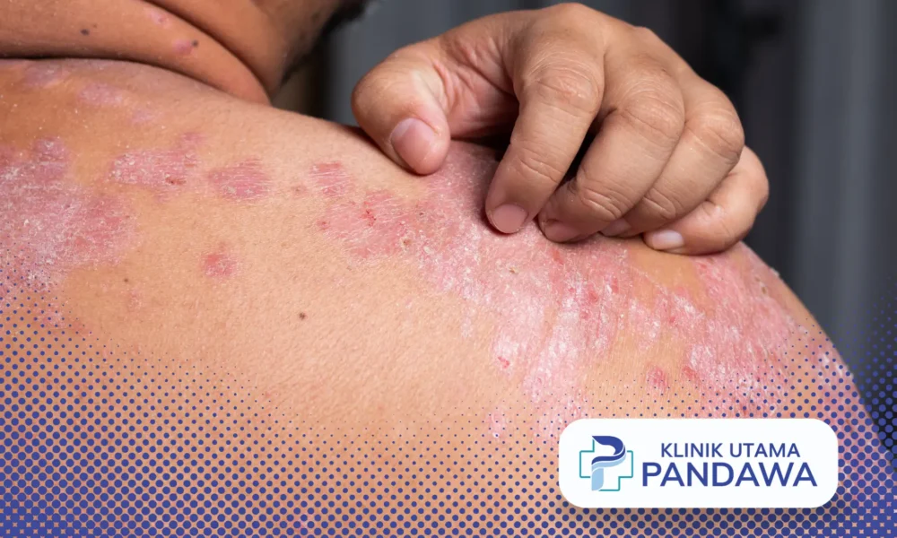 Dermatitis