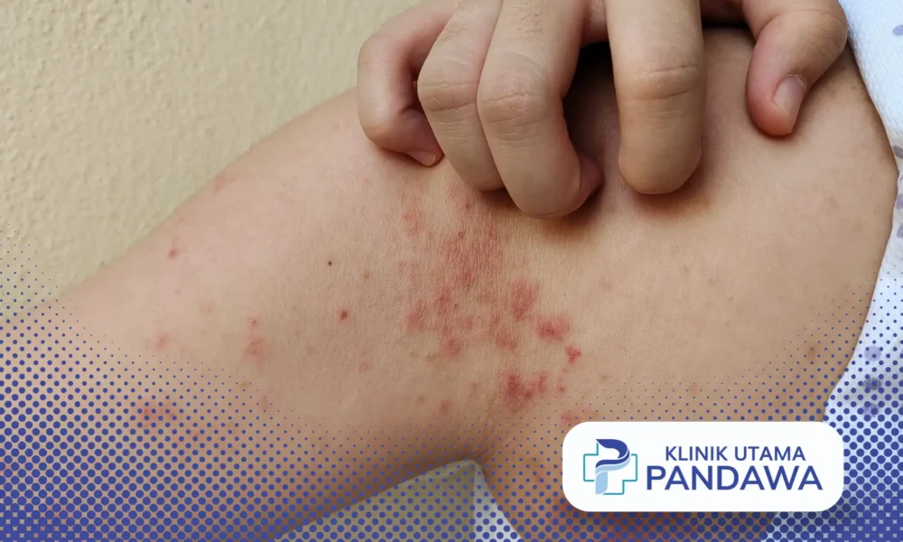 Impetigo