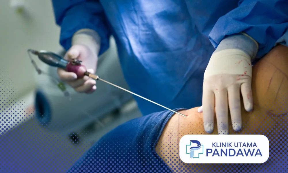 Liposuction